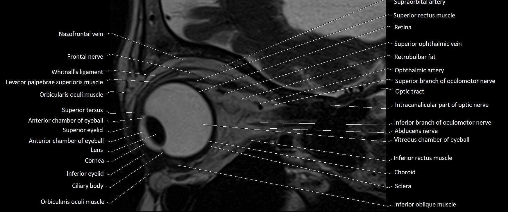 MRI Orbit sagittal cross sectional anatomy 3T image 8.webp